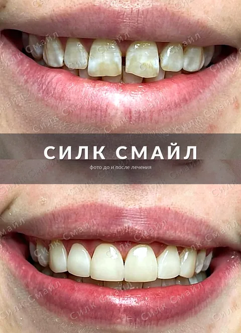 Композитная реставрация зубов — фото до и после, работа клиники Силк Смайл, пример 1
