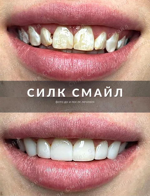 Композитная реставрация зубов — фото до и после, работа клиники Силк Смайл, пример 2