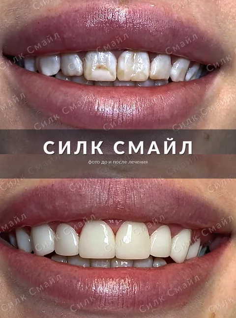 Композитная реставрация зубов — фото до и после, работа клиники Силк Смайл, пример 3