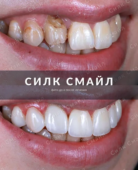 Композитная реставрация зубов — фото до и после, работа клиники Силк Смайл, пример 4