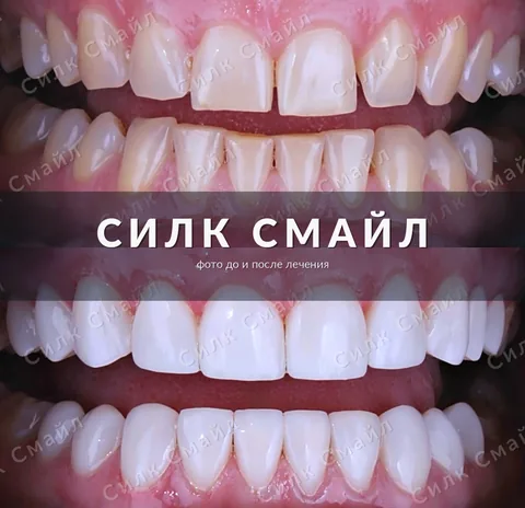Композитная реставрация зубов — фото до и после, работа клиники Силк Смайл, пример 7