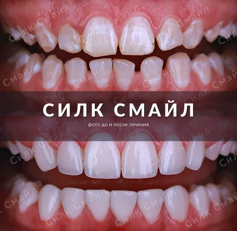 Композитная реставрация зубов — фото до и после, работа клиники Силк Смайл, пример 8
