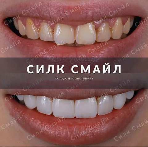 Композитная реставрация зубов — фото до и после, работа клиники Силк Смайл, пример 11