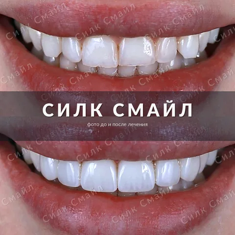 Композитная реставрация зубов — фото до и после, работа клиники Силк Смайл, пример 13