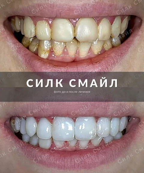 Композитная реставрация зубов — фото до и после, работа клиники Силк Смайл, пример 14
