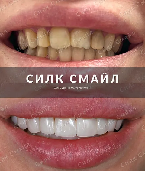 Композитная реставрация зубов — фото до и после, работа клиники Силк Смайл, пример 15